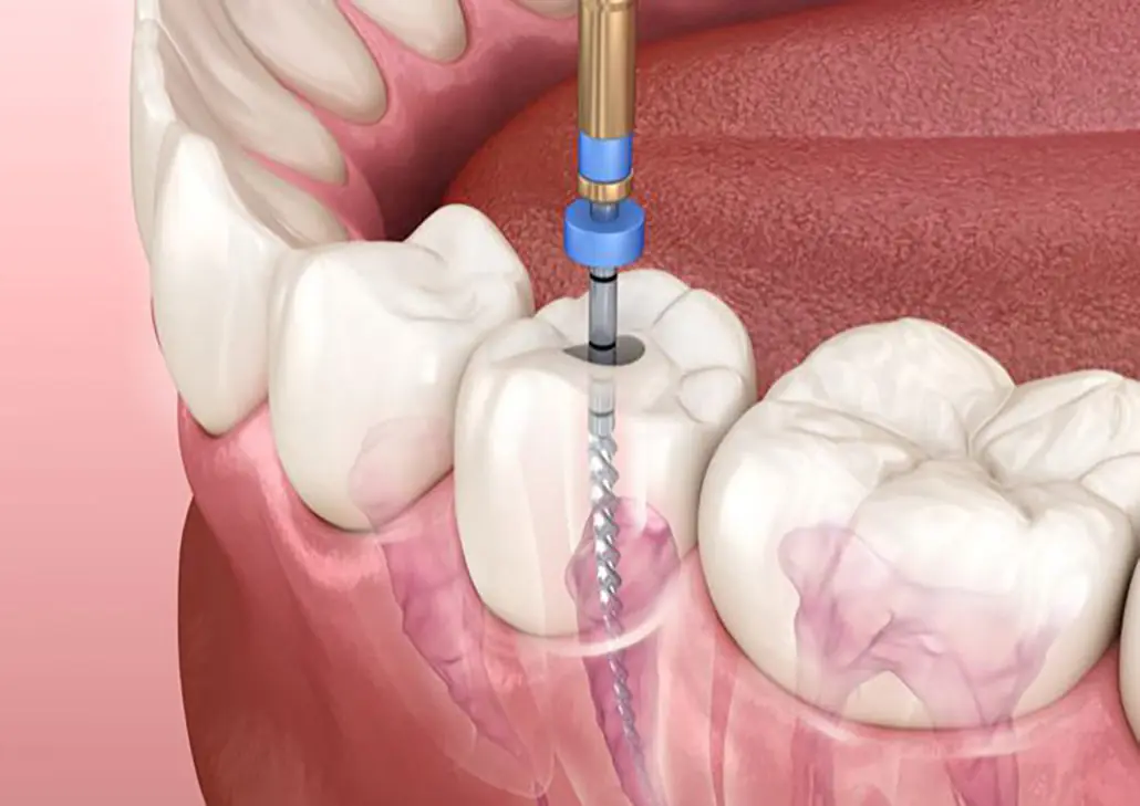 Tratamento de Canal: Por Que Vale a Pena Salvar o Dente