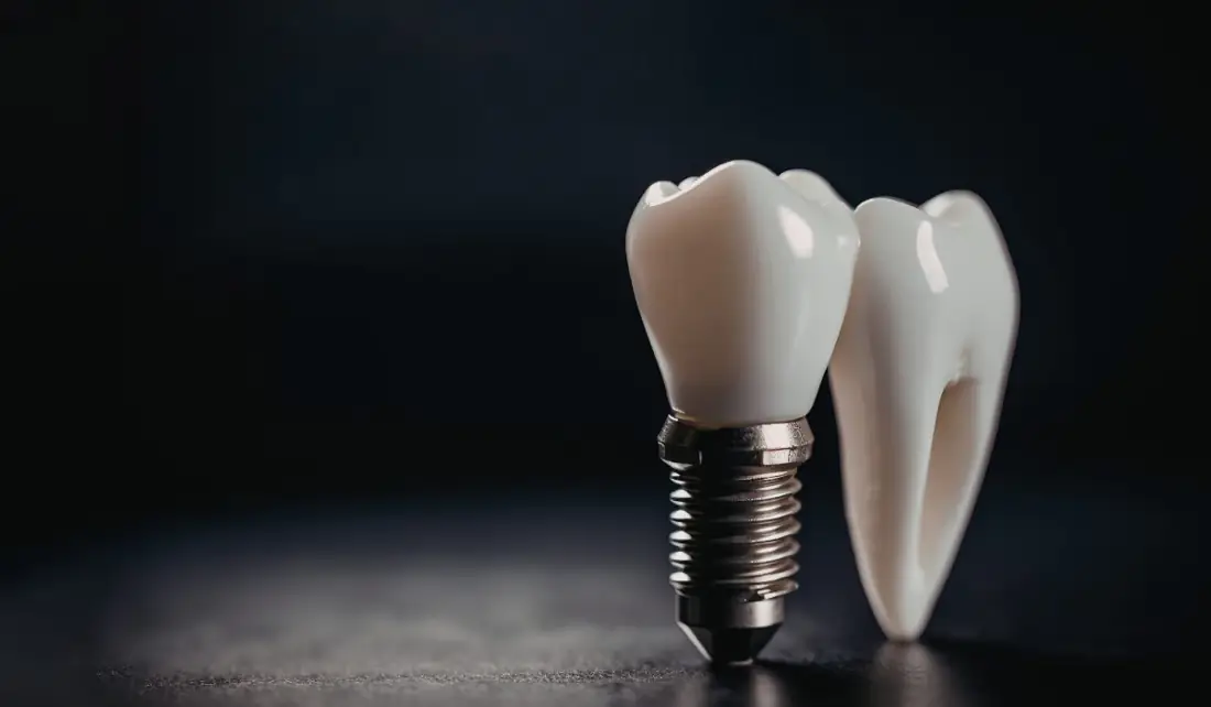 Implantes Dentários