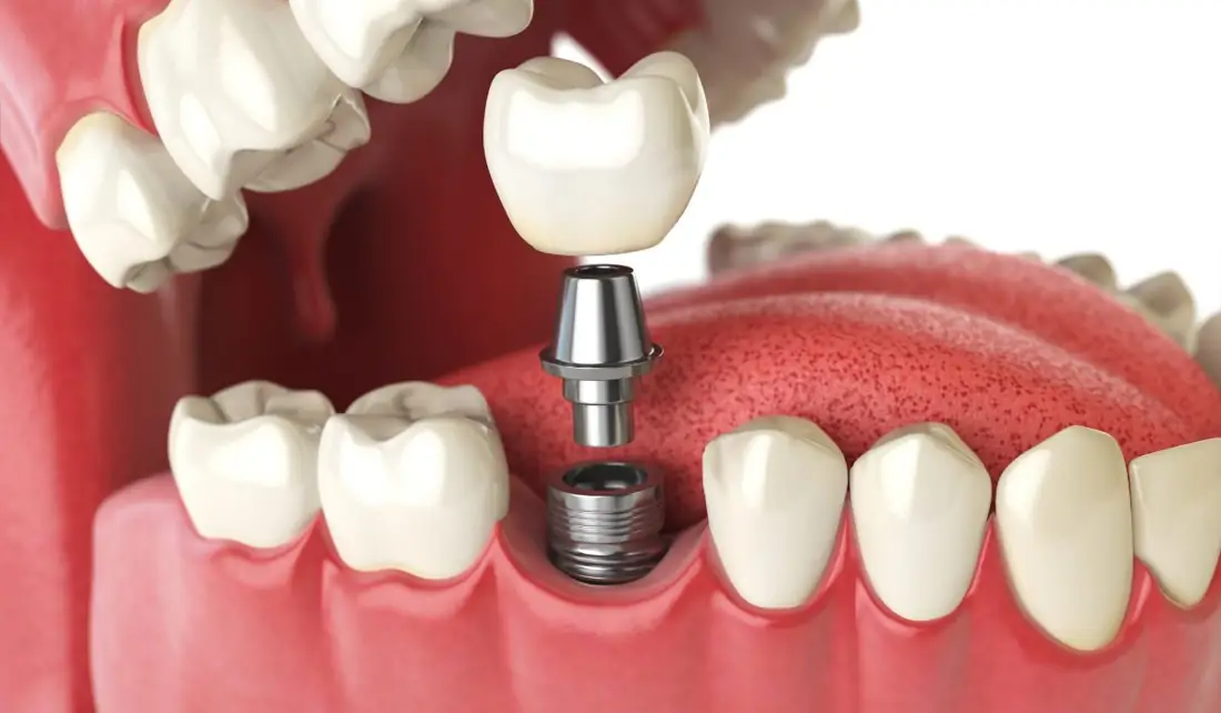 Como Funciona o Implante Dentário, Etapa por Etapa