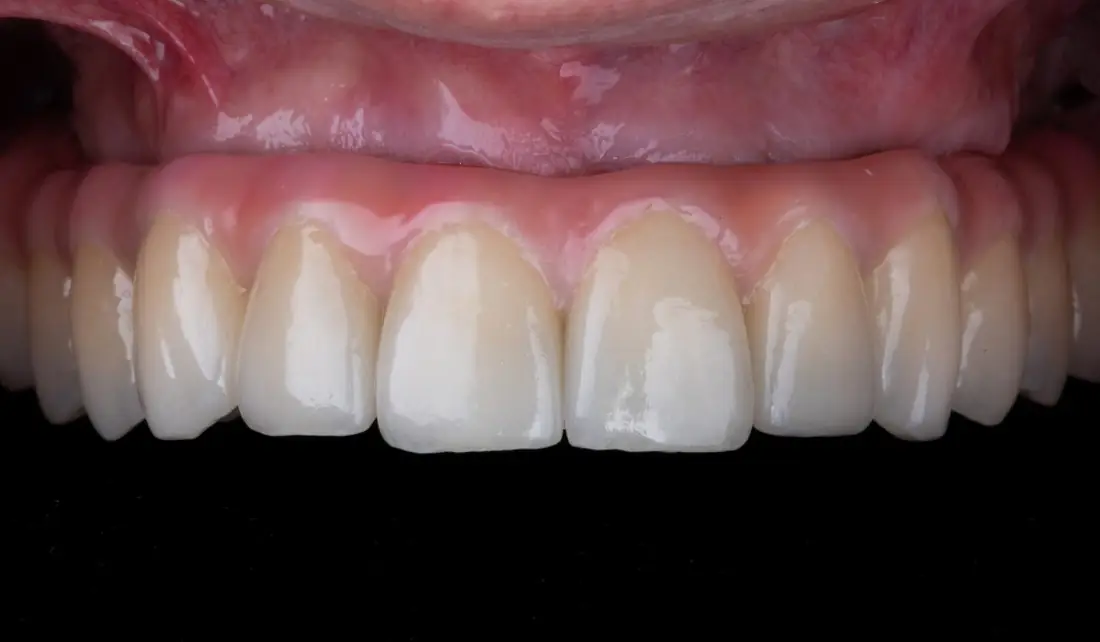 Próteses Dentárias