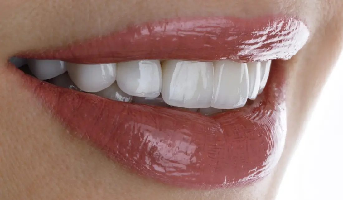 Clareamento Dental: O Que Saber Antes de Fazer